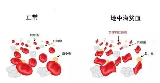 地中海貧血者買哪個險種好？還能買到重疾險嗎？插圖
