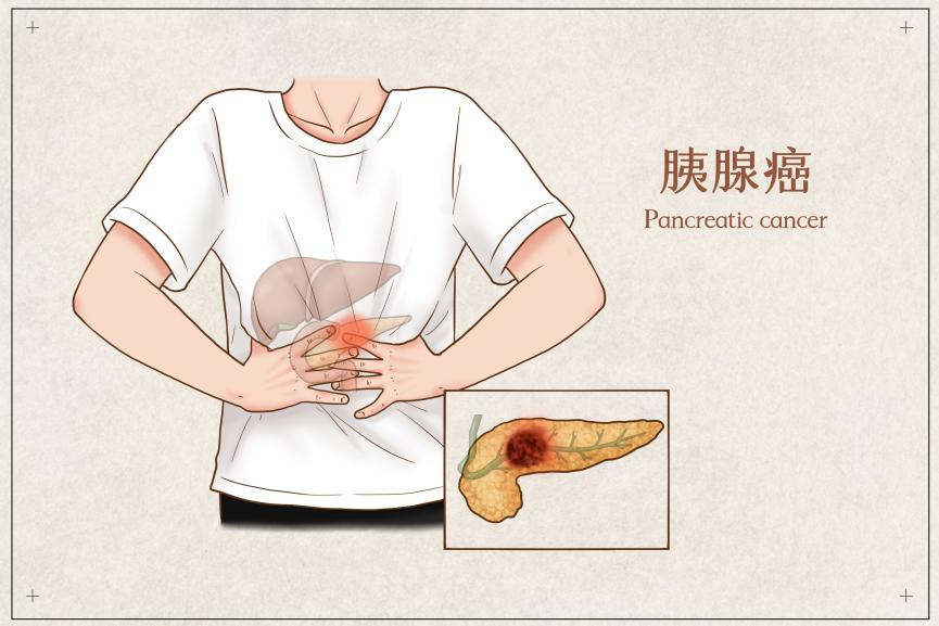 這種癌症一查出就是晚期？5個早期信號千萬要留意插圖