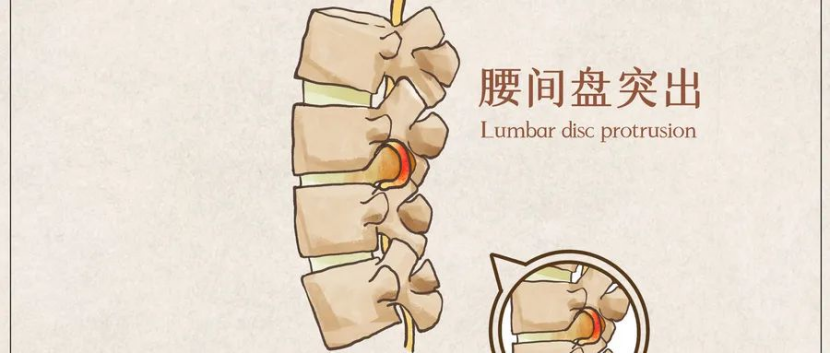 打工人坐姿不對引起的頸椎病、腰突竟然會影響買保險！插圖4