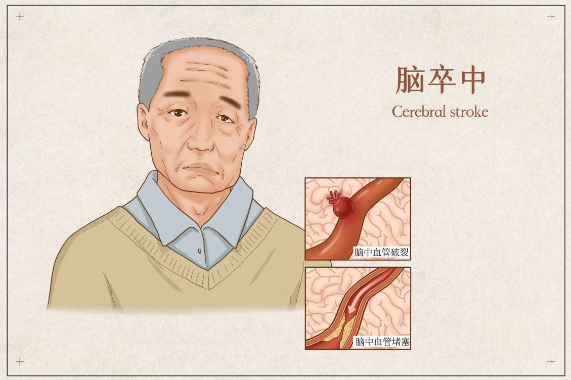 發生腦中風,保險理賠難嗎?插圖 發生腦中風,保險理賠難嗎?插圖