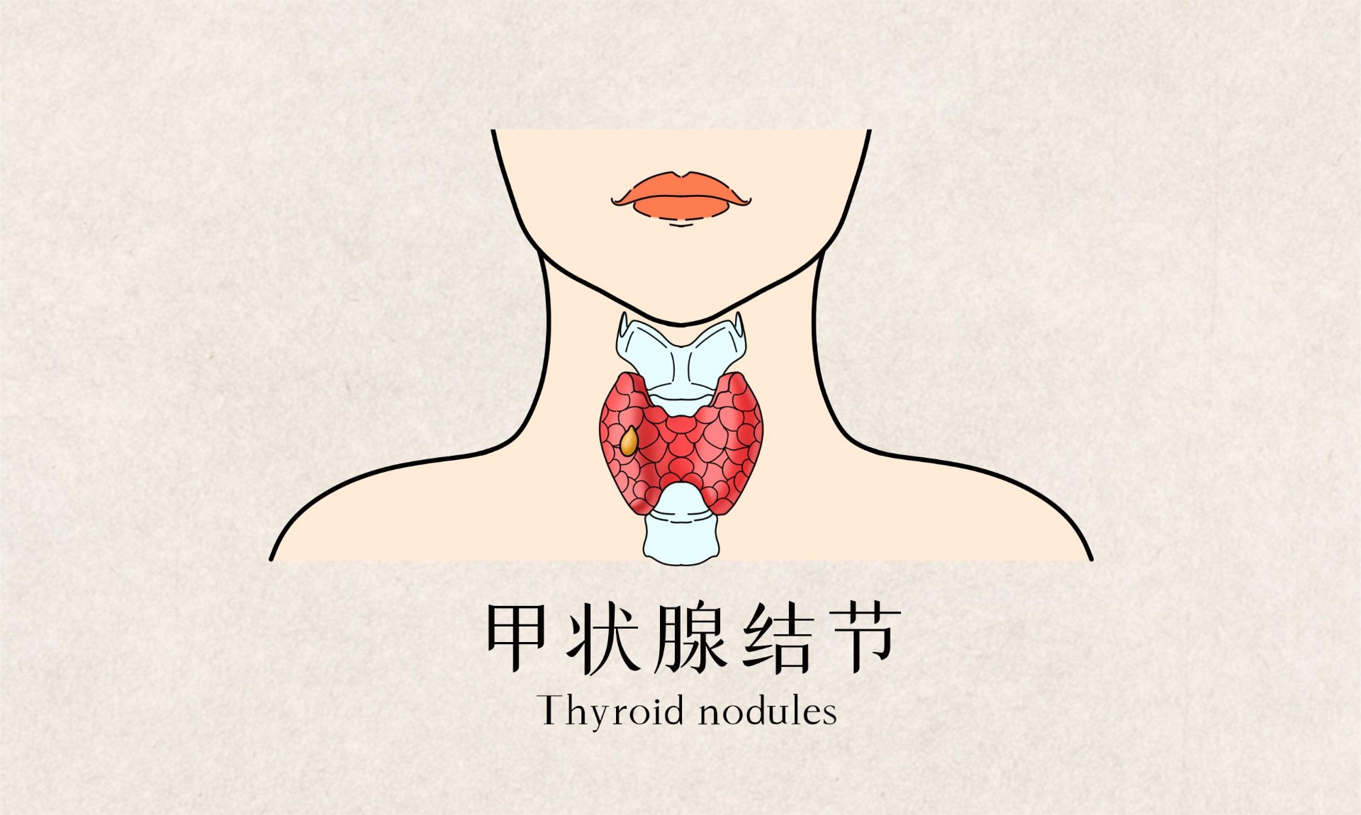 甲狀腺結節，癌變的可能性大嗎？插圖2