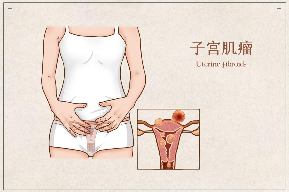 子宮肌瘤做手術，百萬(wan) 醫療險能報銷嗎？插圖2