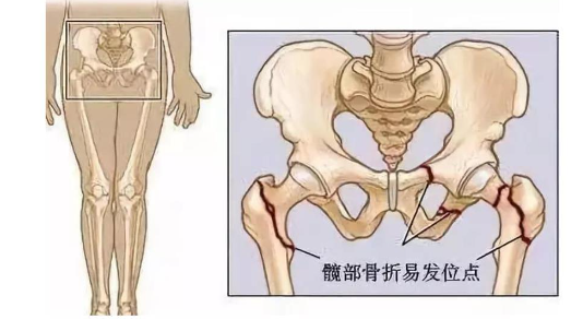 隻是摔了一跤，終身癱瘓在床……插圖2