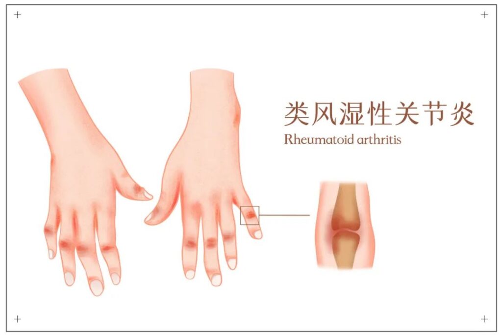 年紀輕輕癱瘓在床,原來身體早有預警……插圖2 年紀輕輕癱瘓在床,原來身體早有預警……插圖2