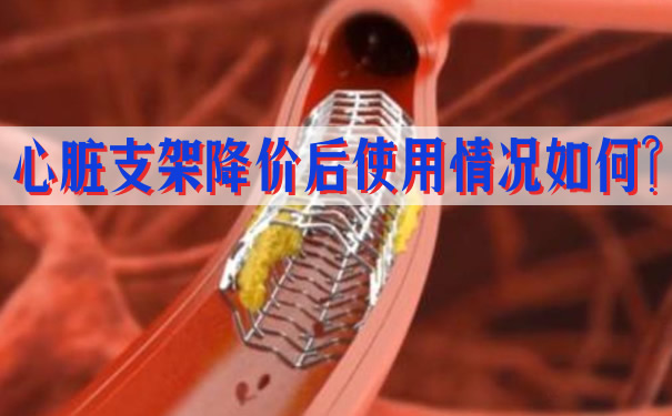 降價(jia) 後心髒支架的使用情況如何？插圖