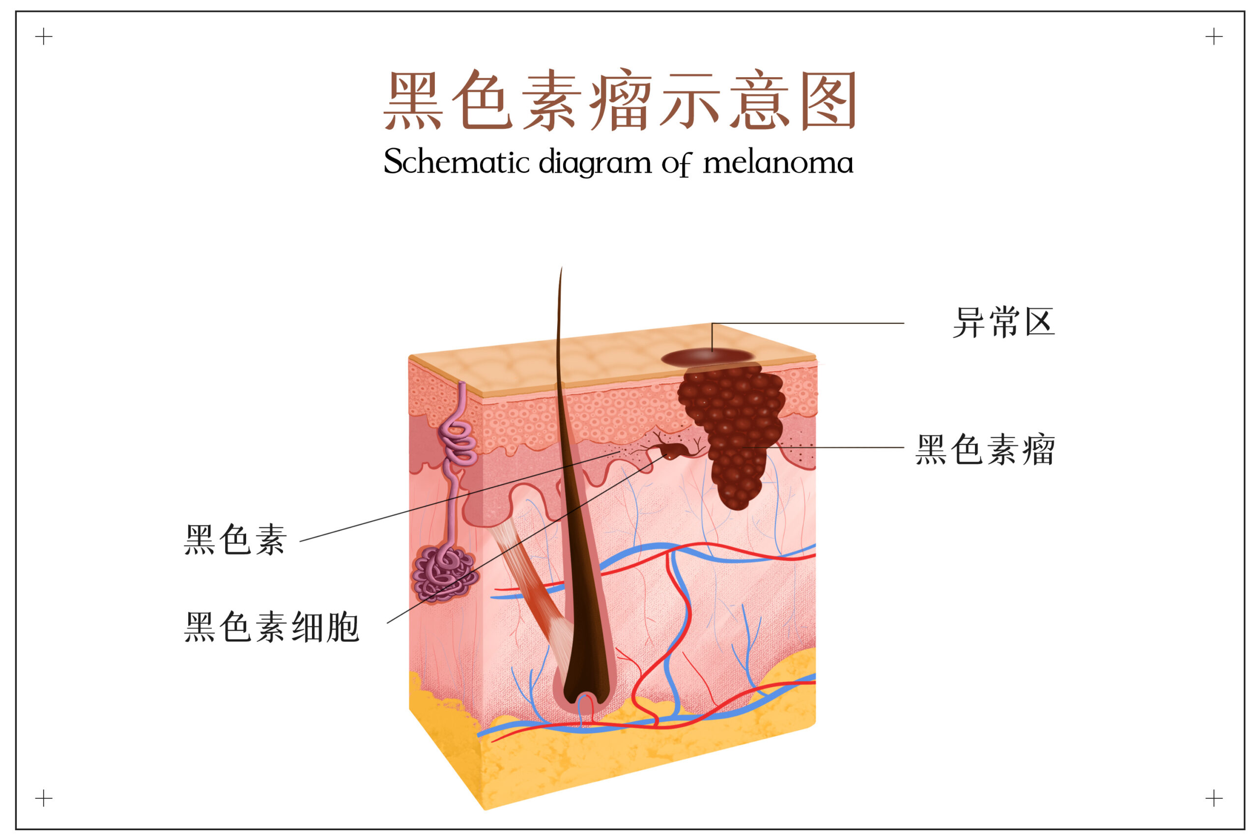 身上長這種痣，當心是瘤！哪些保險能賠？插圖2