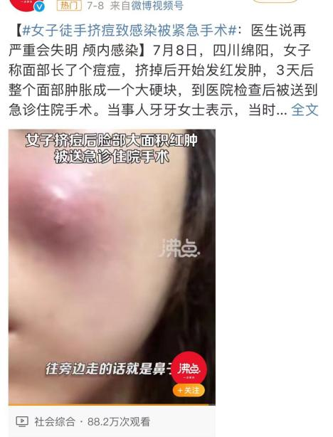 擠三角區痘痘，小心後果嚴重插圖2