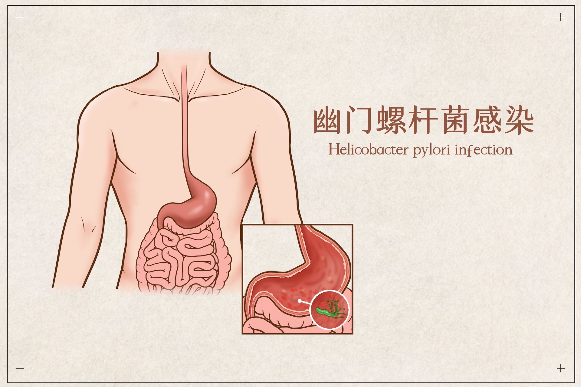 幽門螺杆菌怎麽(me) 傳(chuan) 播的？有什麽(me) 症狀？插圖3