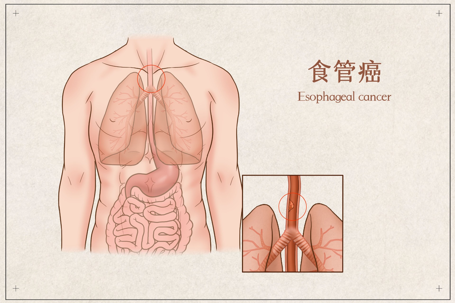 不幸得食管癌，保險賠嗎？插圖3