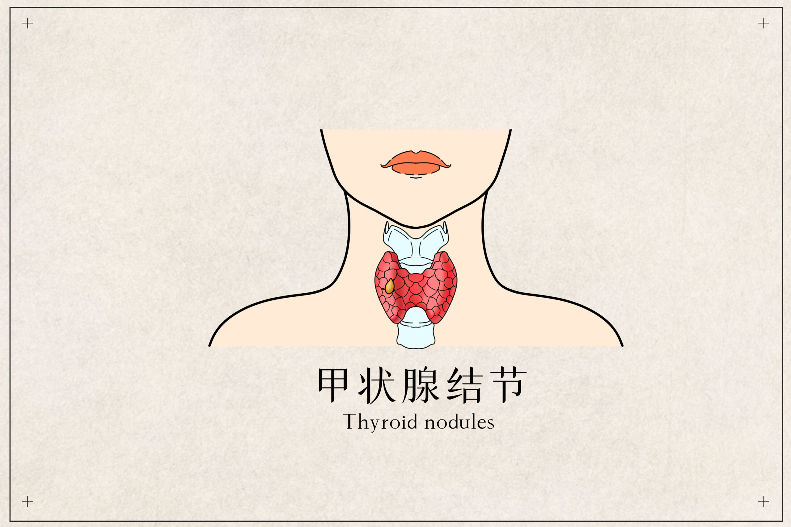 結節離癌症有多遠？女性體檢常見的異常指標，哪個更要命？插圖2
